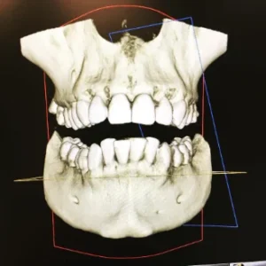 ESTUDIO IMPLANTOLÓGICO 3D (CON TAC) GRATUITO REALIZADO POR EL DR. BALTAR, Y 10% DE DESCUENTO ADICIONAL EN TRATAMIENTOS DE IMPLANTOLOGÍA.
